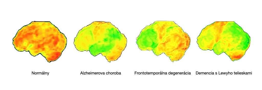 PET: Vzorce aktivity nervových buniek v rámci hlavných príčin rozvoja demencie