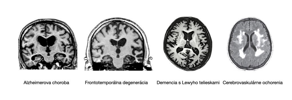 MRI: Vzorec zmenšovania objemu mozgu a lézií v rámci hlavných príčin rozvoja demencie