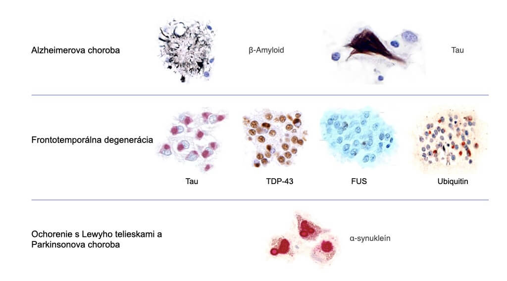 Depozity proteínov pri neurodegeneratívnych ochoreniach